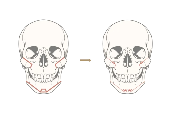 Jaw Angle, Cheekbone, and Chin Osteotomies for Facial Slimming and Contouring