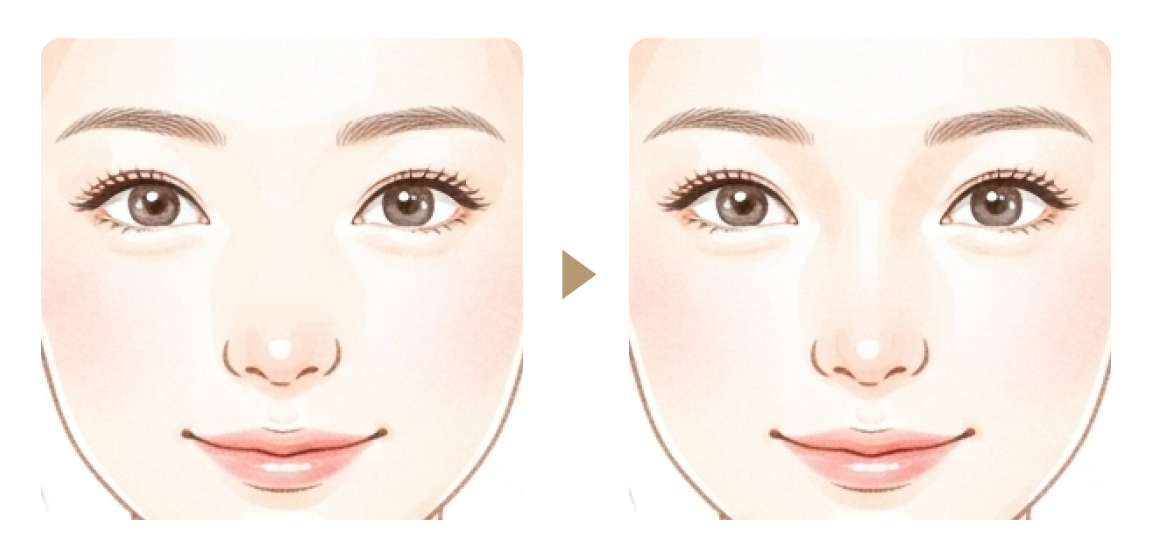 隆鼻術のbefore&after画像