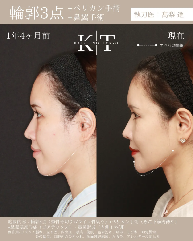 輪郭3点　骨切り　症例