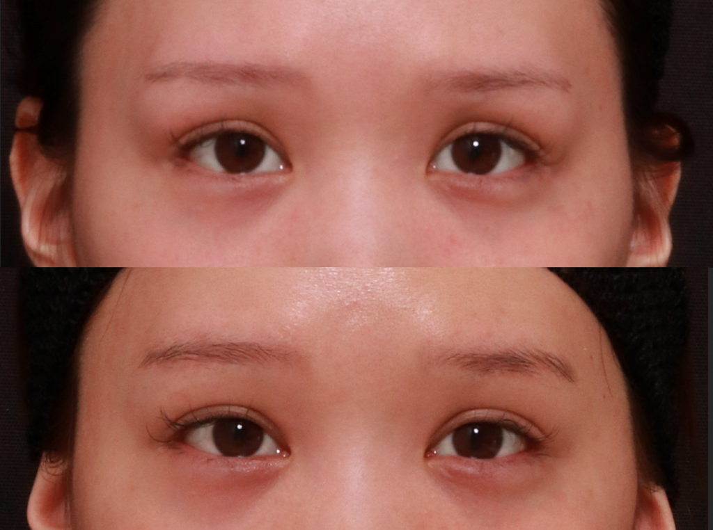眉骨削り　症例