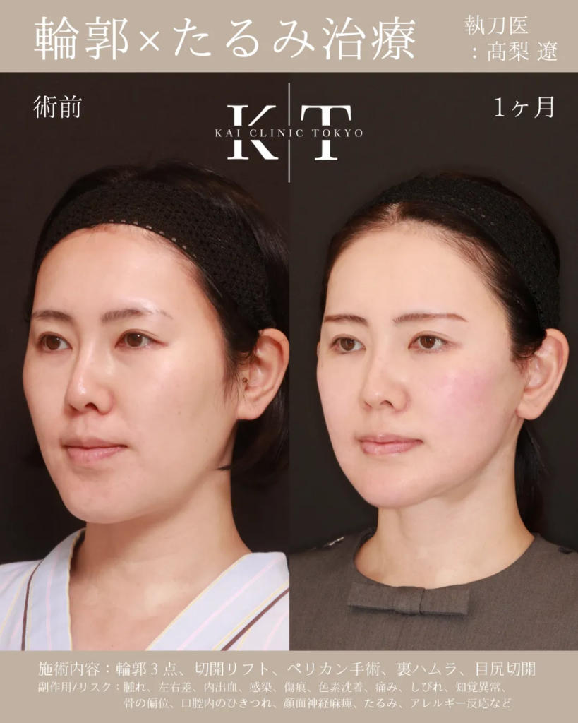 輪郭　整形　たるみ治療　症例