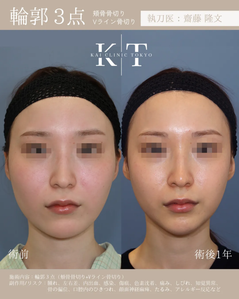 輪郭3点　頬骨骨切り　Vライン骨切り　症例