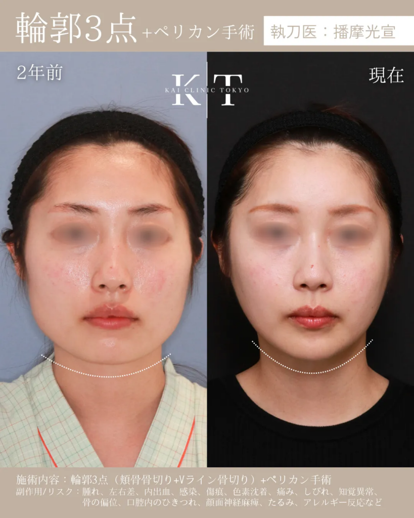 輪郭3点　頬骨骨切り　Vライン骨切り　ペリカン手術　症例