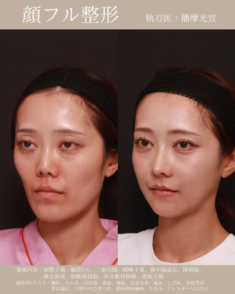 顔　フル整形　症例