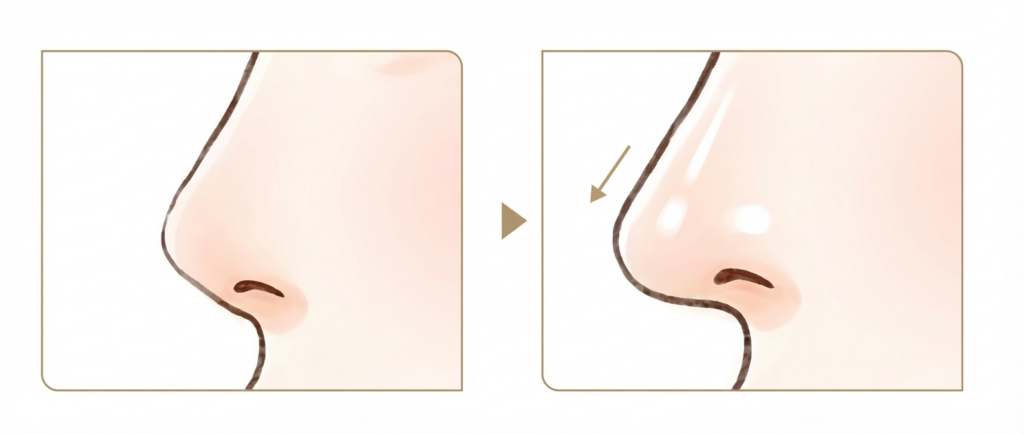 鼻先整形　鼻中隔延長術