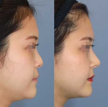 鼻先整形　鼻フル整形