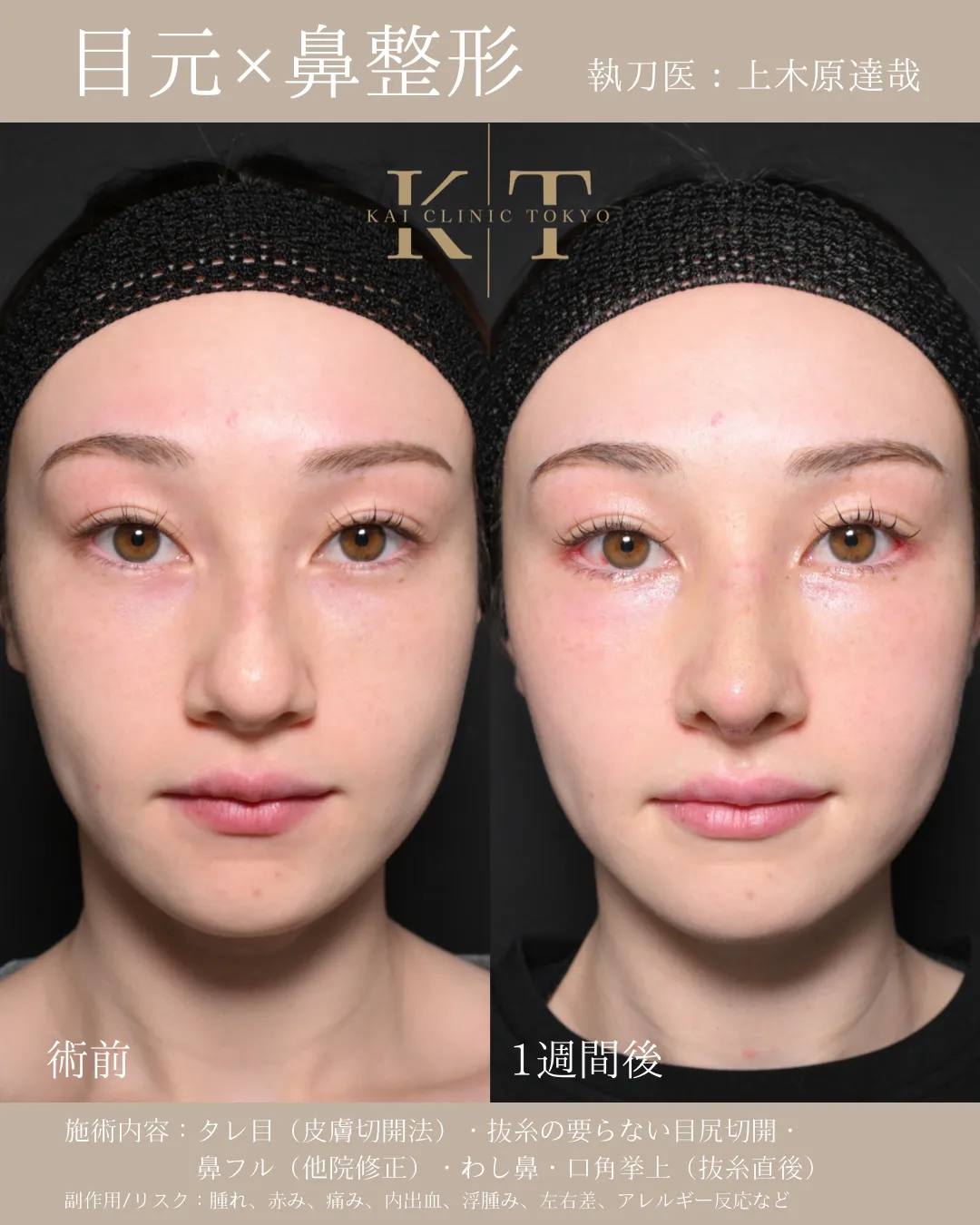 目元×鼻整形【20代女性】