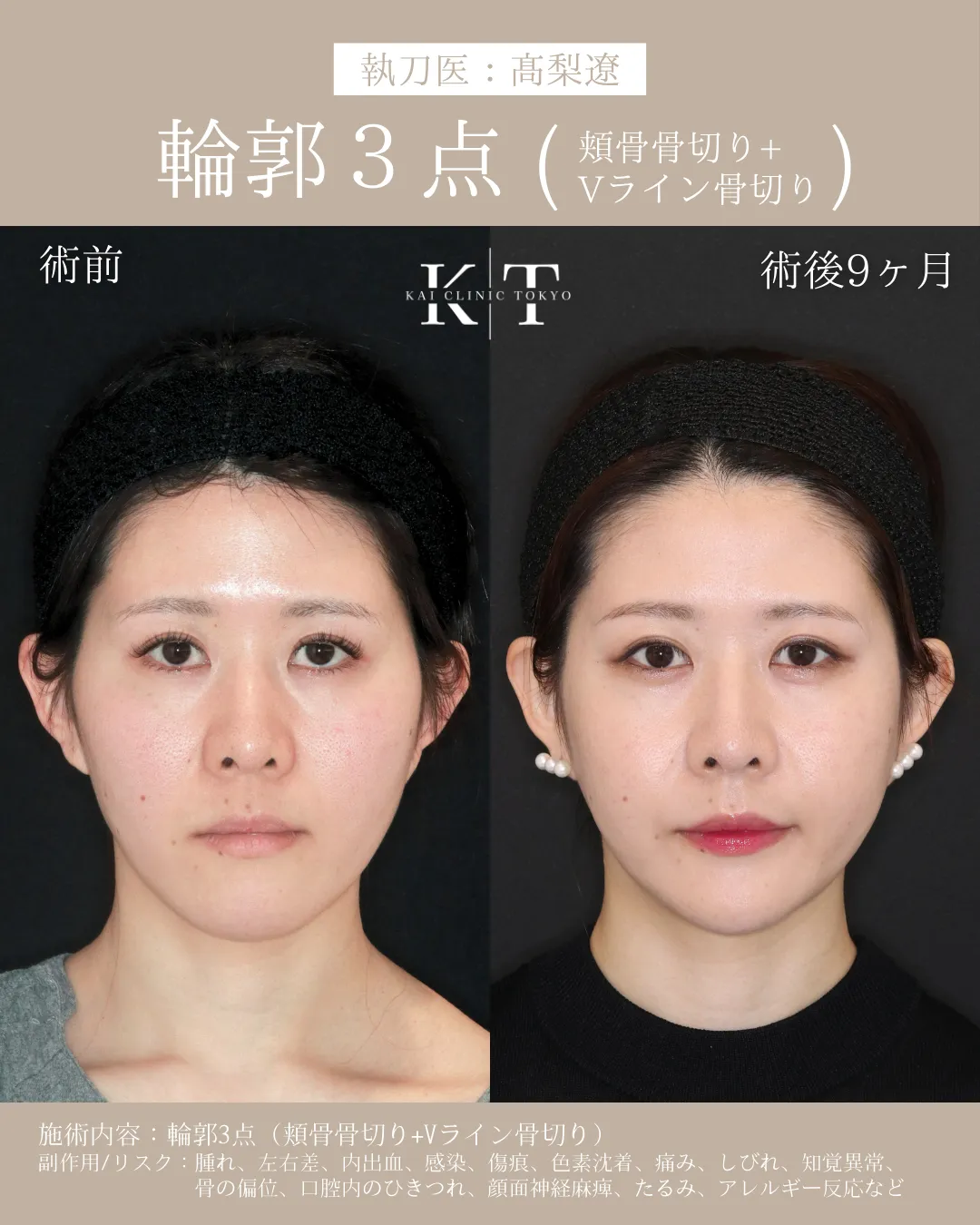 輪郭3点（頬骨骨切り+Vライン形成）【20代女性】