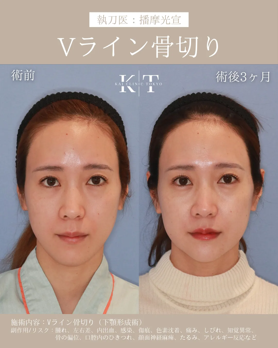 Vライン形成【20代女性】