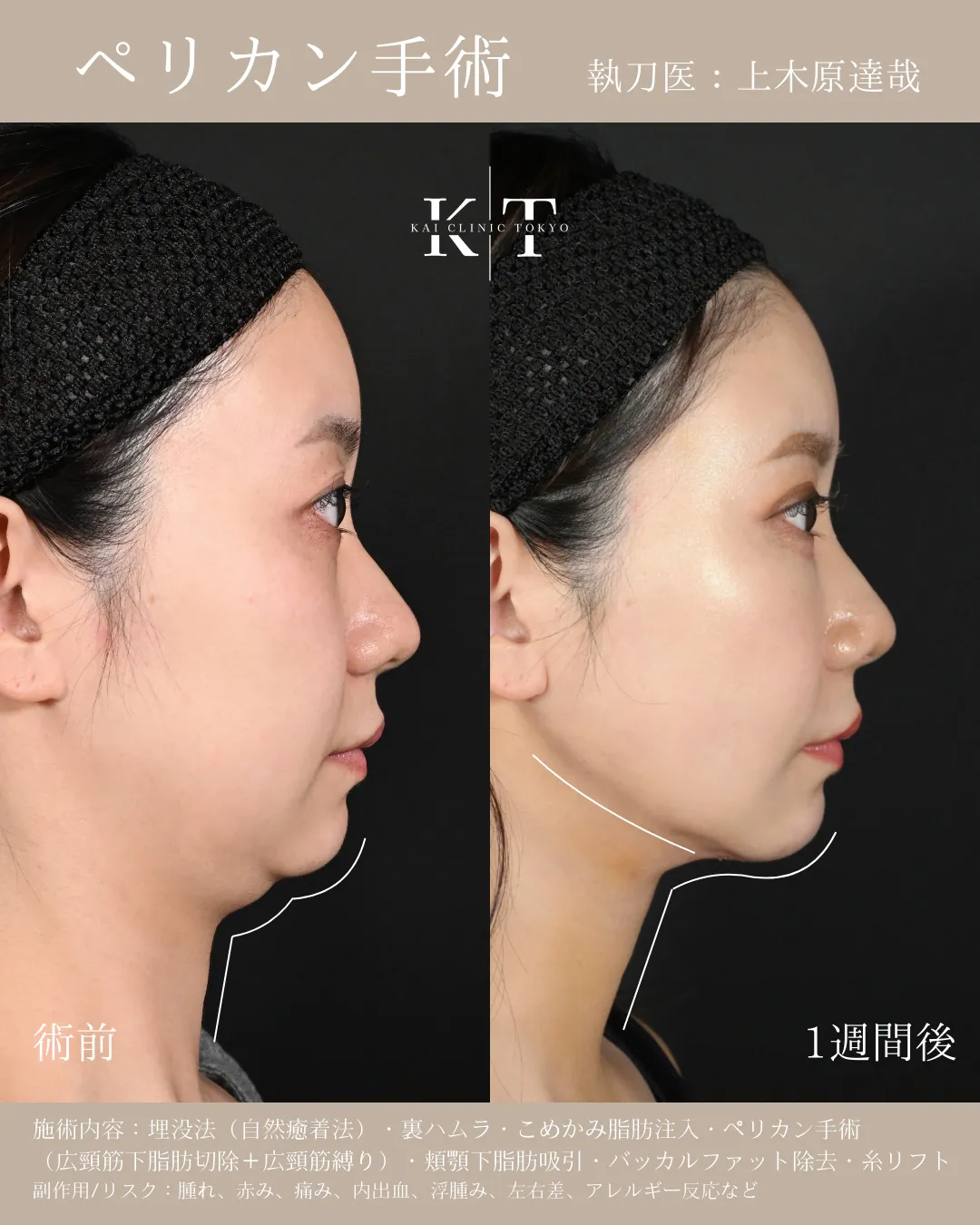ペリカン手術【30代女性】