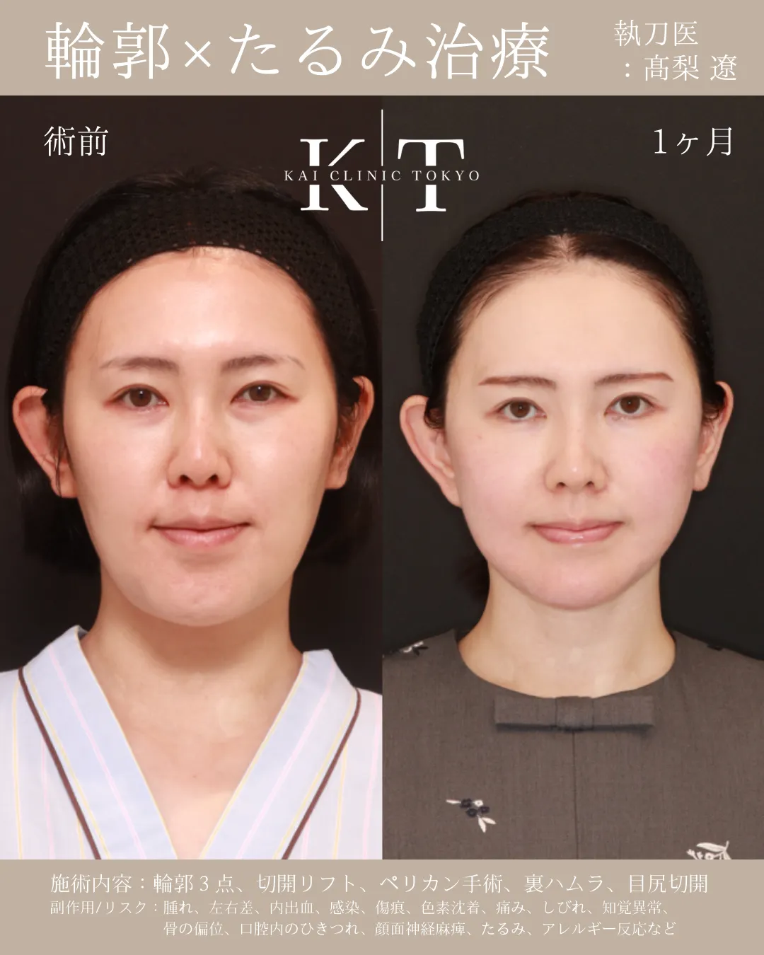 輪郭×たるみ治療【40代女性】