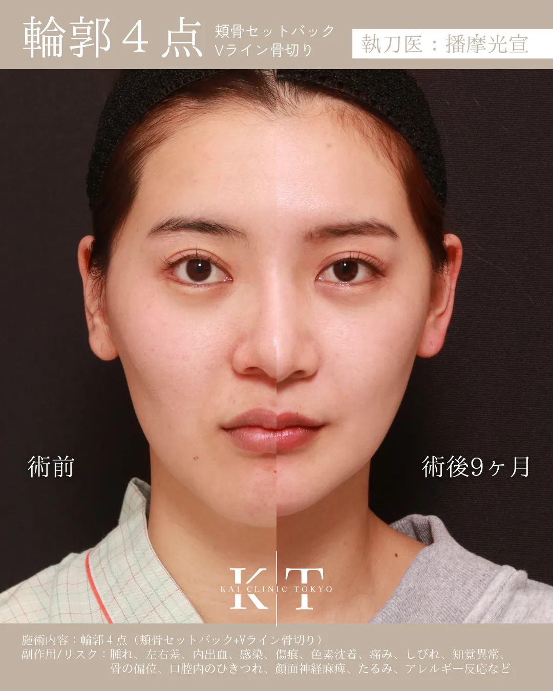 輪郭4点【女性】