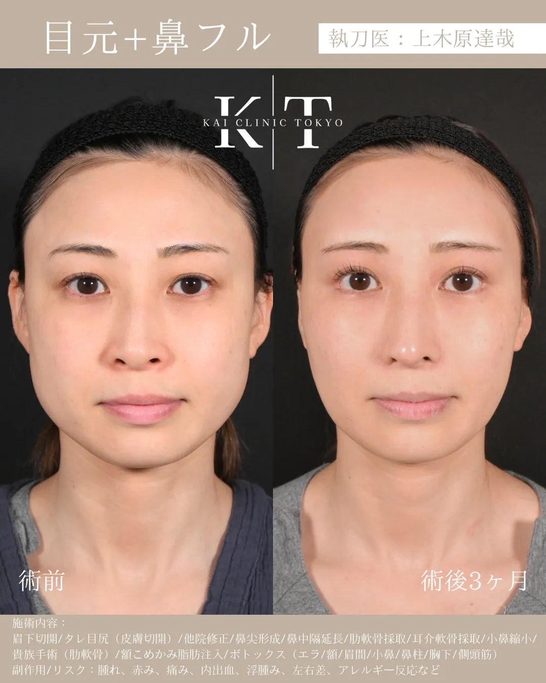 目元＋鼻フル【30代女性】