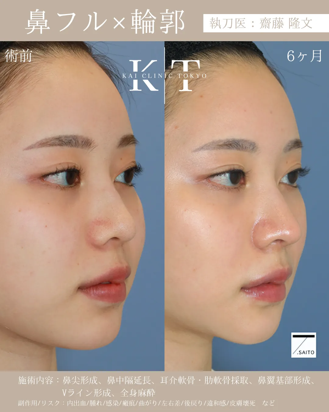 鼻フル【女性】