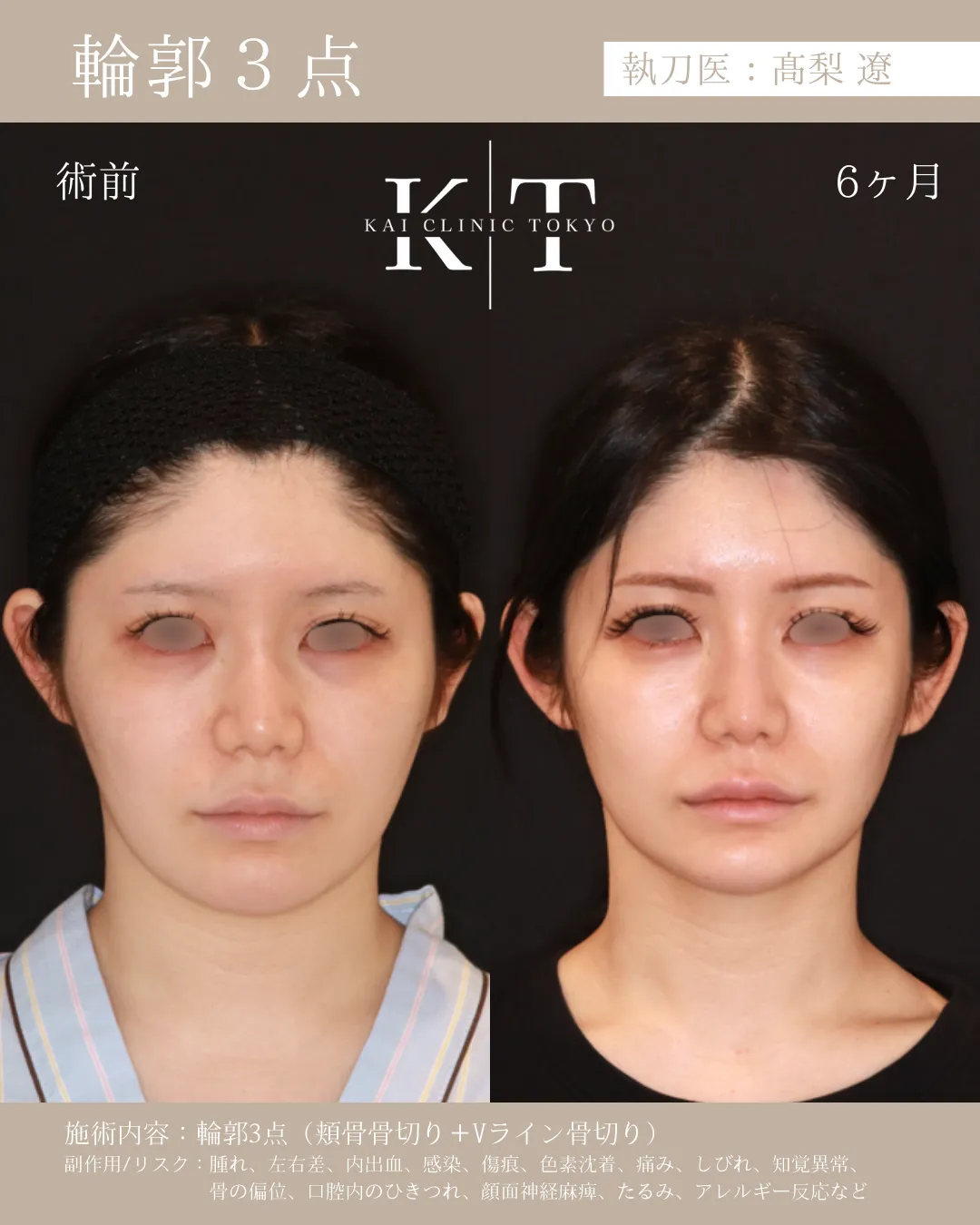 輪郭3点【女性】