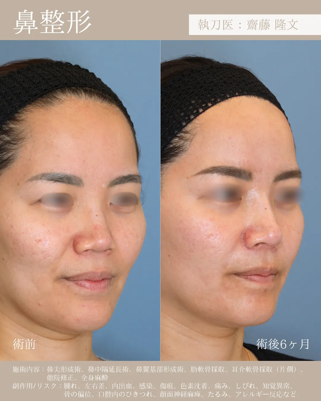 鼻整形【女性】