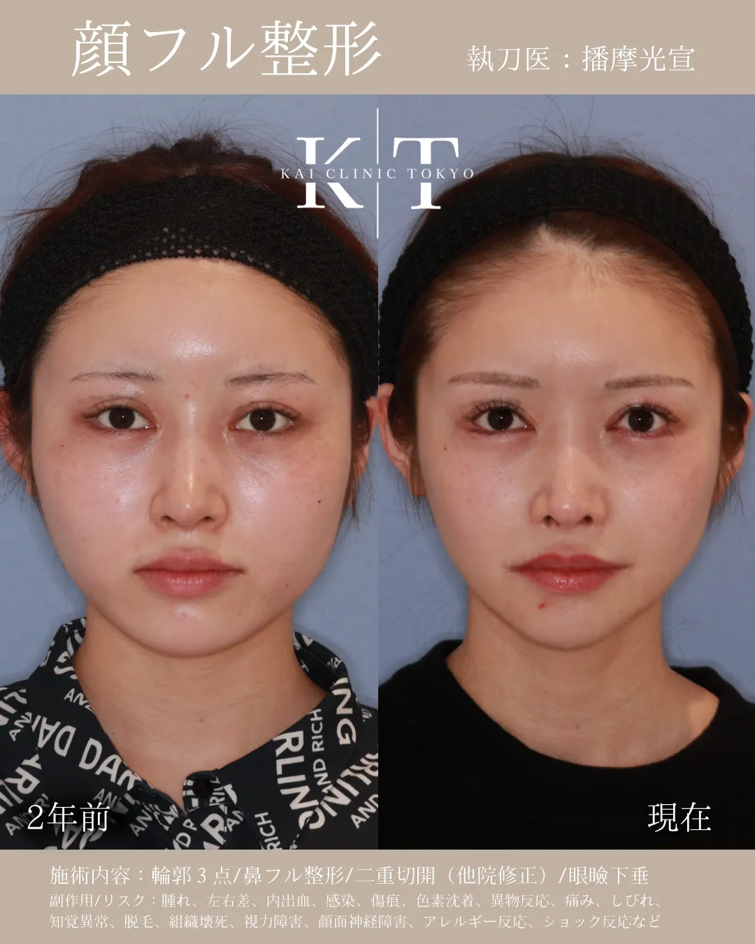 顔フル【20代女性】