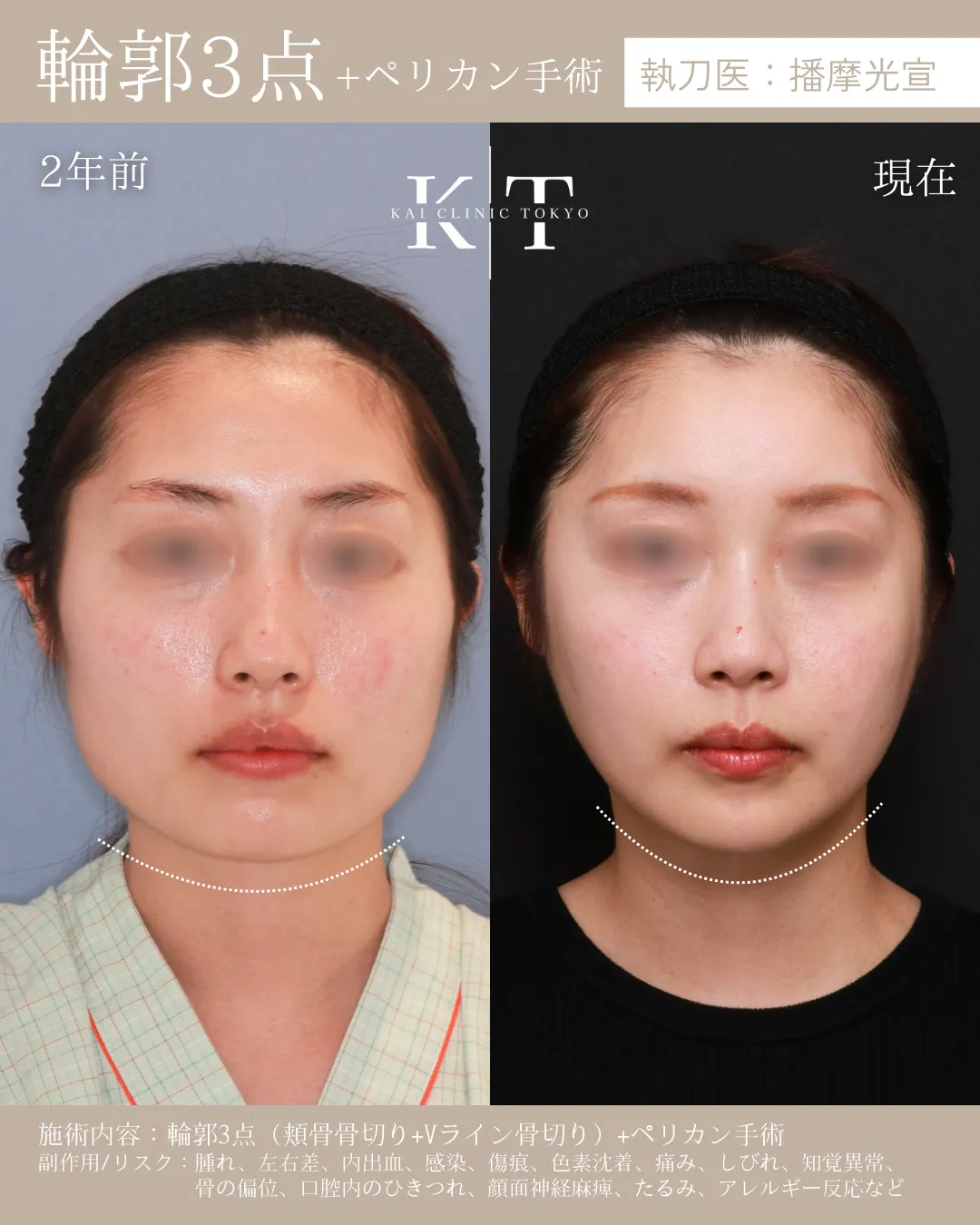 輪郭3点＋ペリカン手術【20代女性】