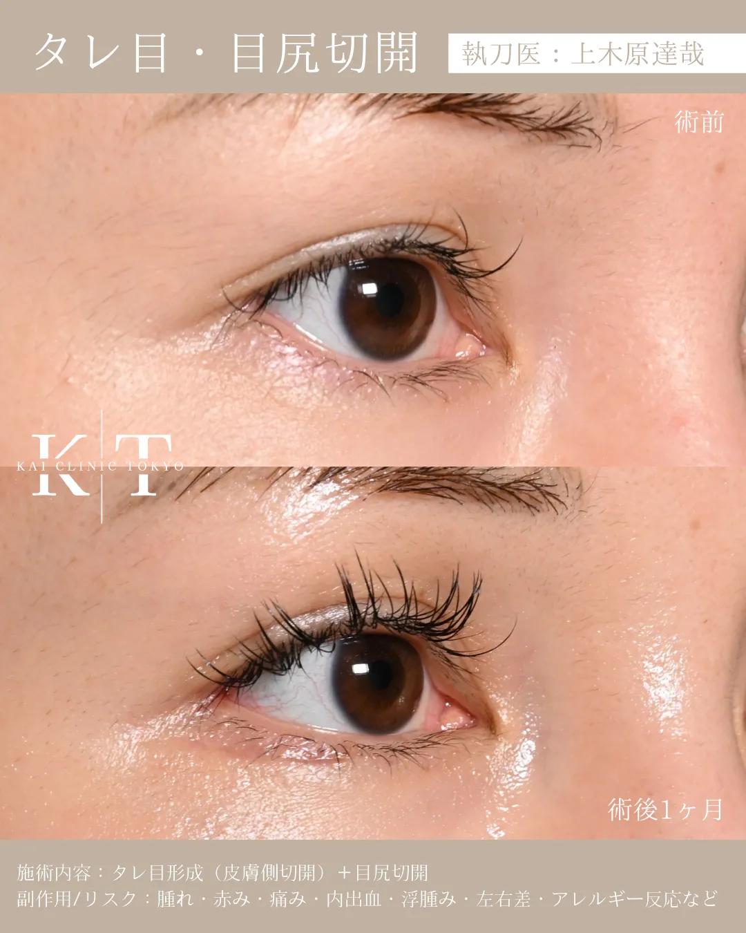 タレ目・目尻切開【30代女性】