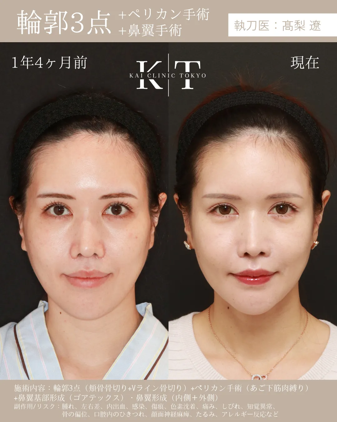 輪郭3点＋ペリカン手術＋鼻翼形成【30代女性】