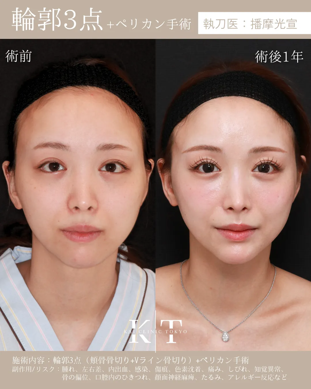 輪郭3点＋ペリカン手術【20代女性】