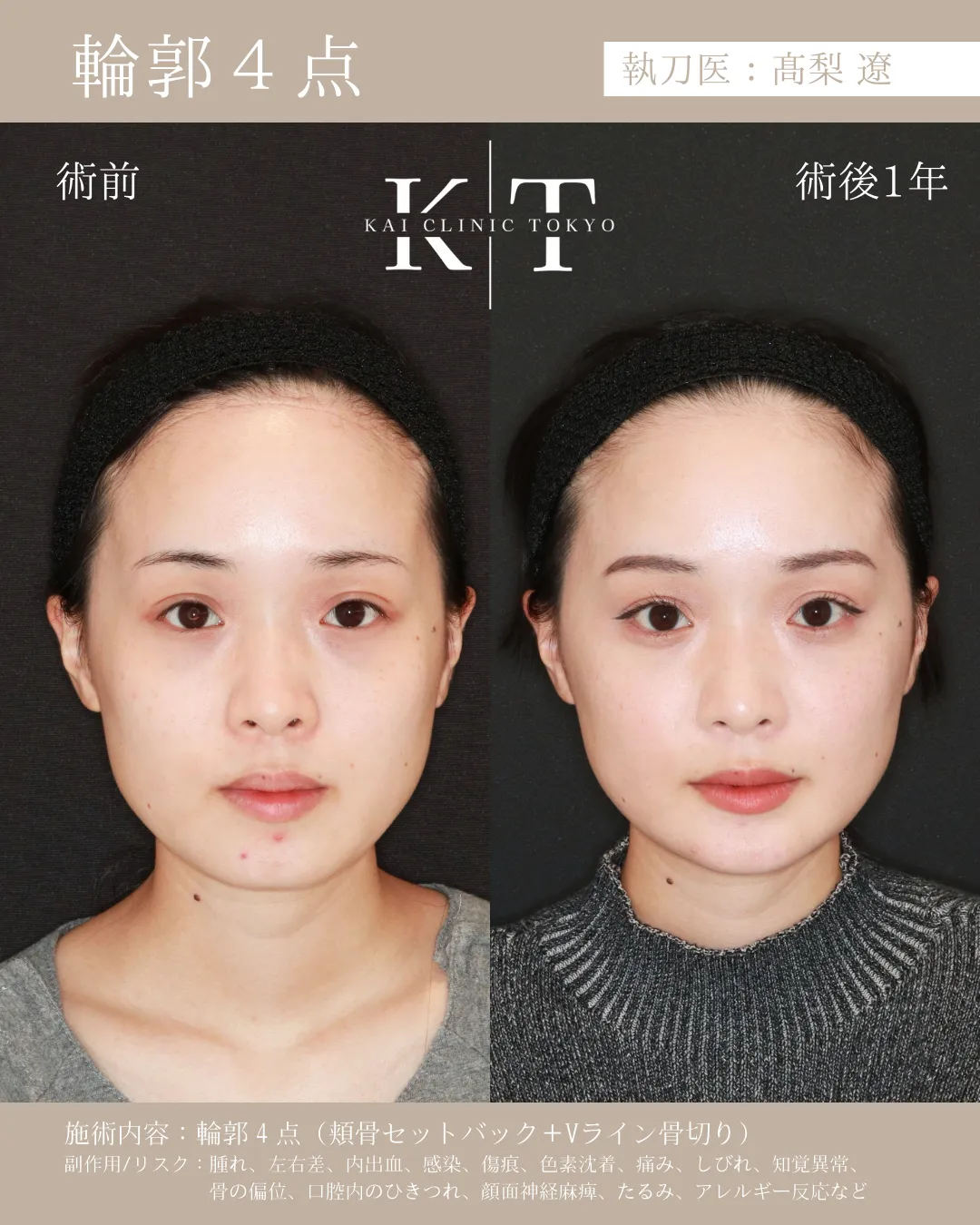 輪郭4点【20代女性】