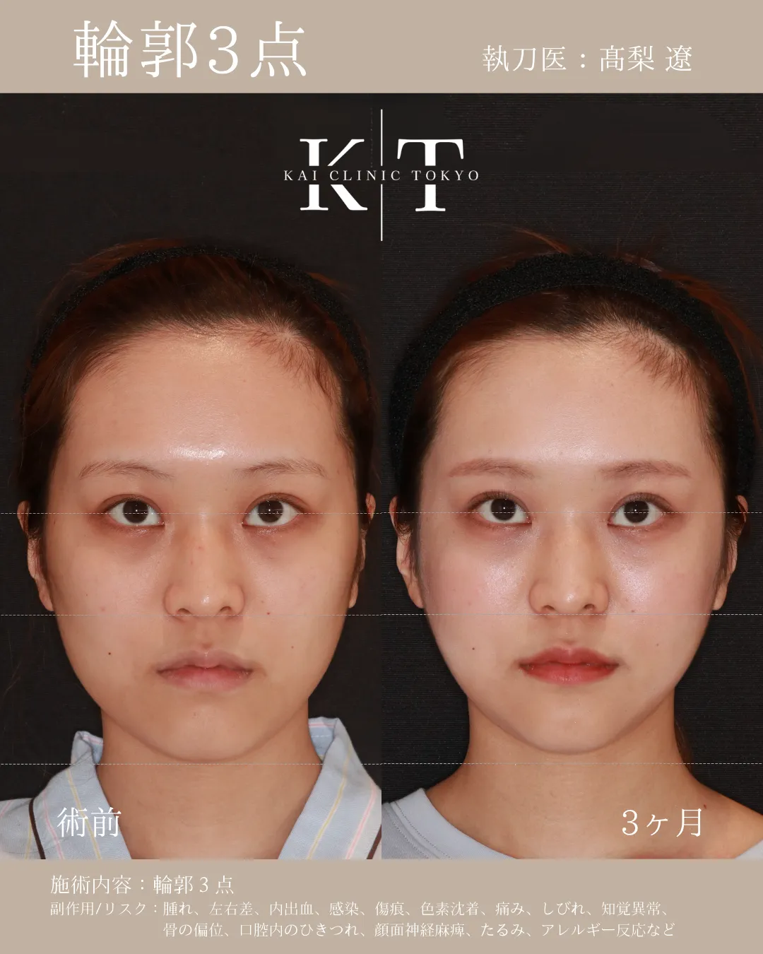 輪郭3点【女性】