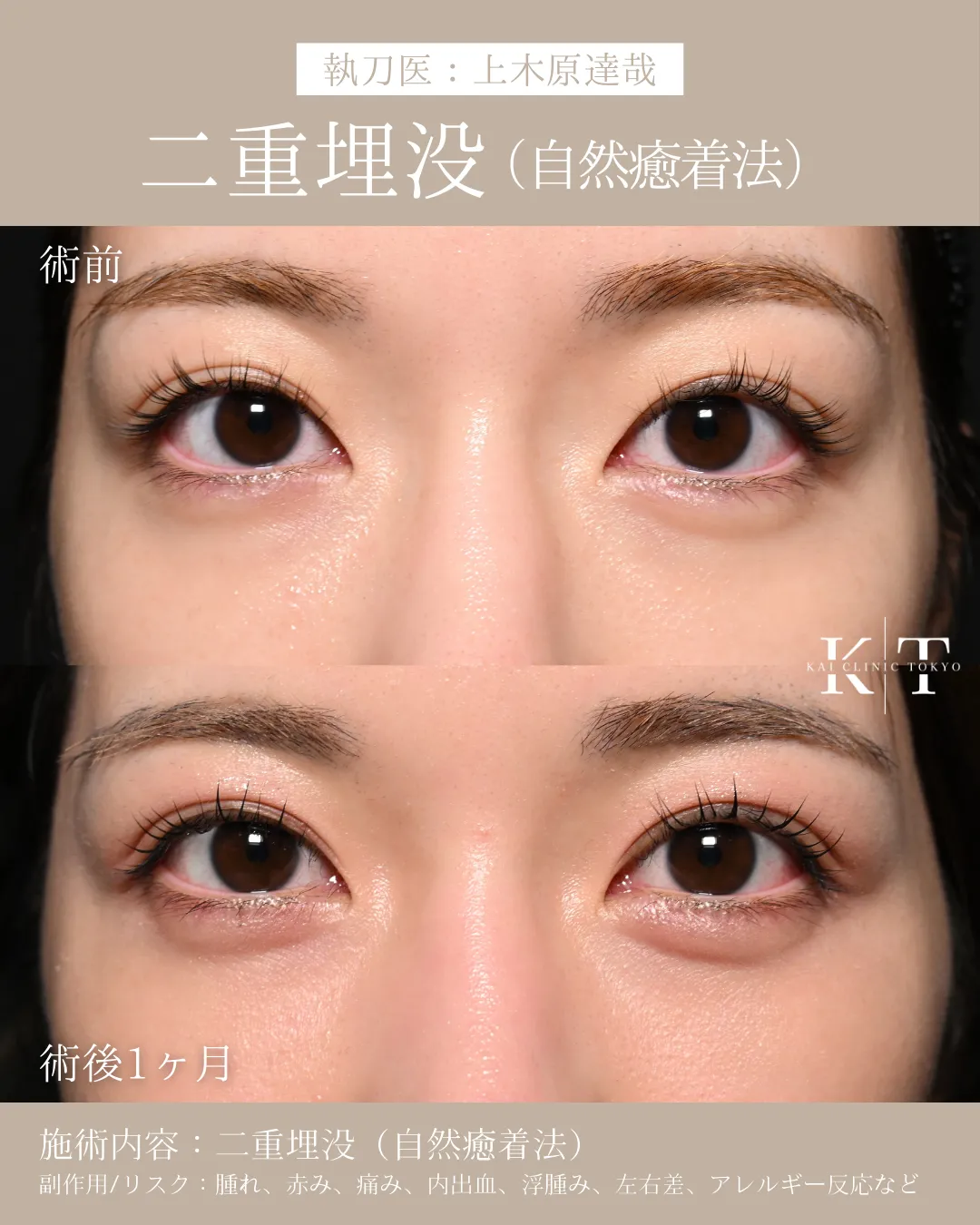 二重埋没（自然癒着法）【20代女性】