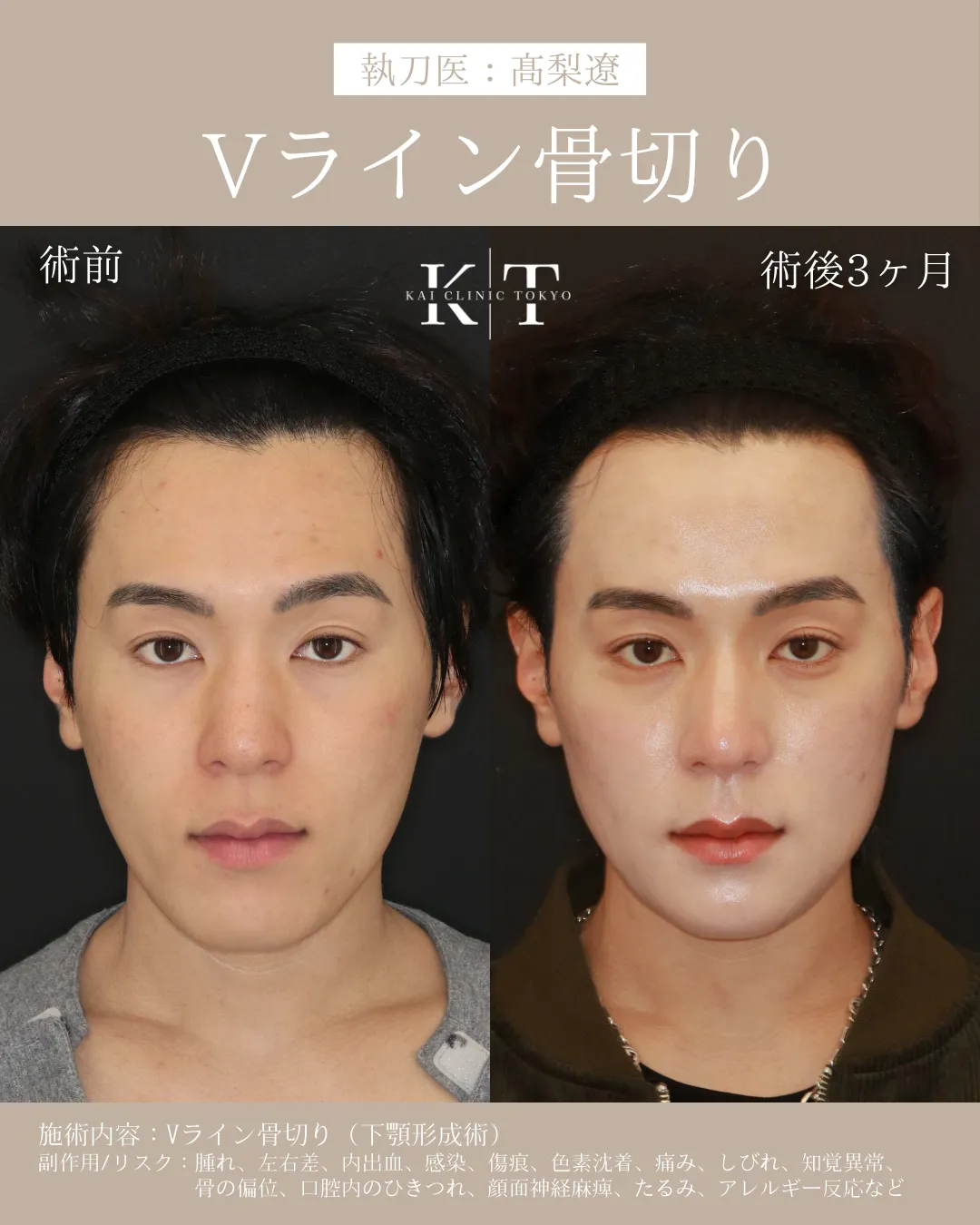 Vライン骨切り（下顎形成術）【20代男性】