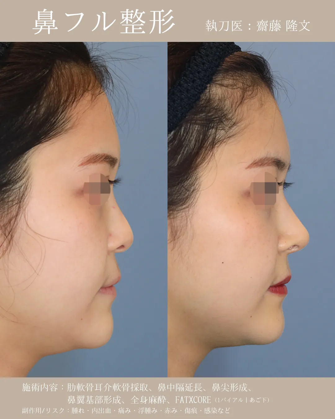 鼻フル【女性】