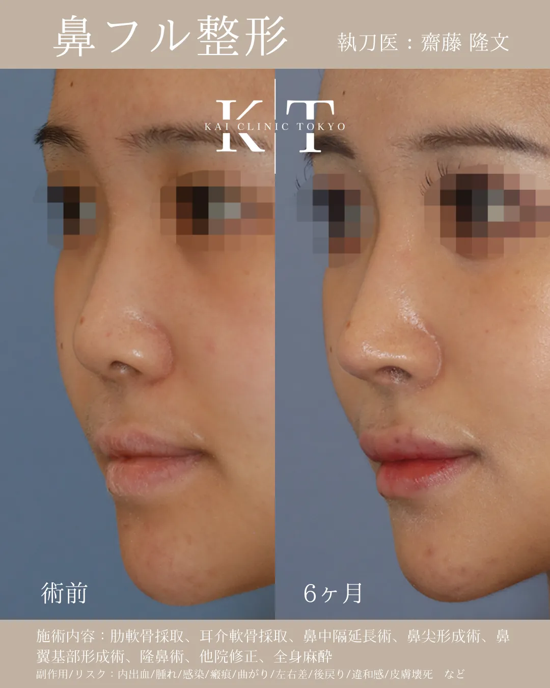 鼻フル【女性】