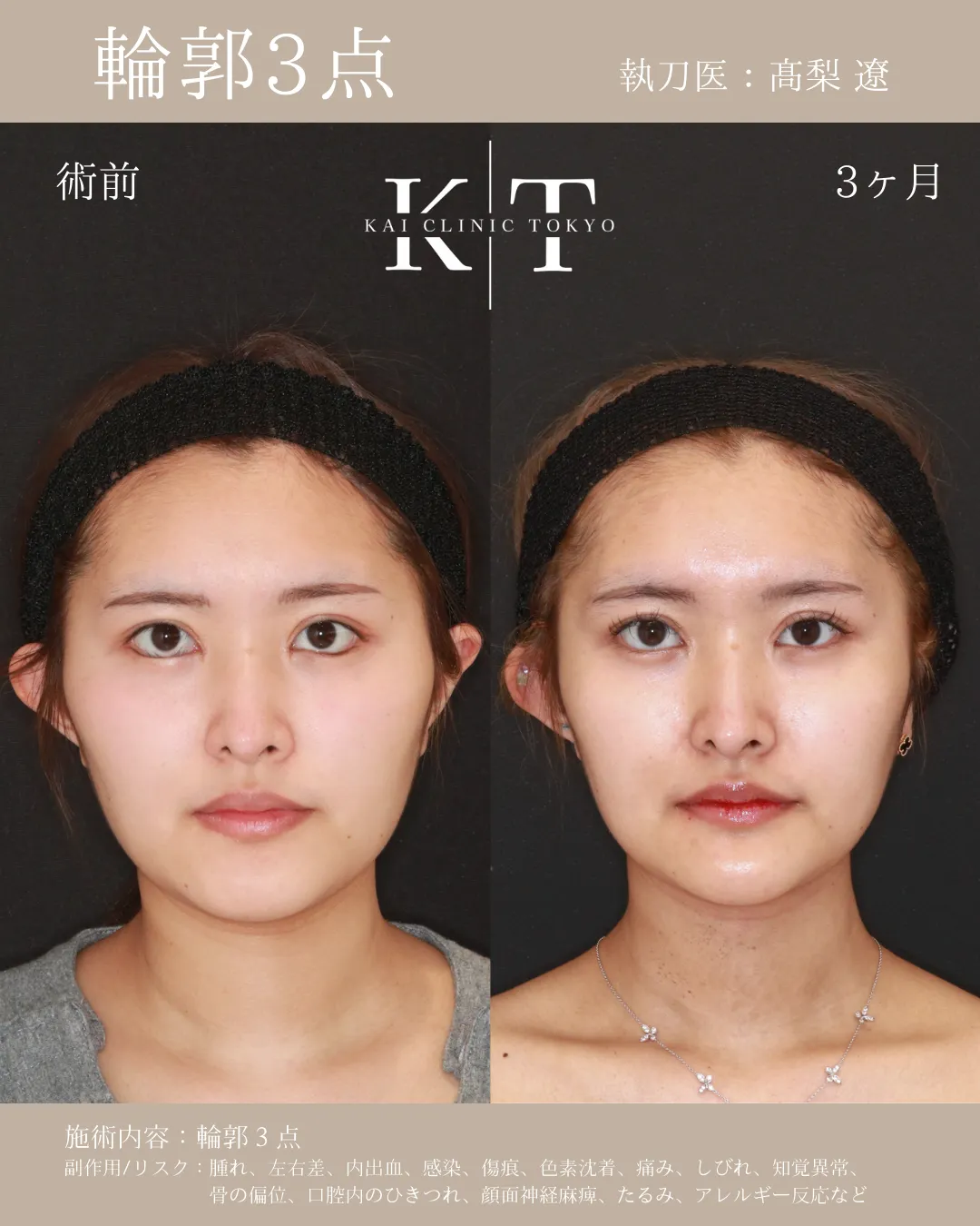 輪郭3点【20代女性】