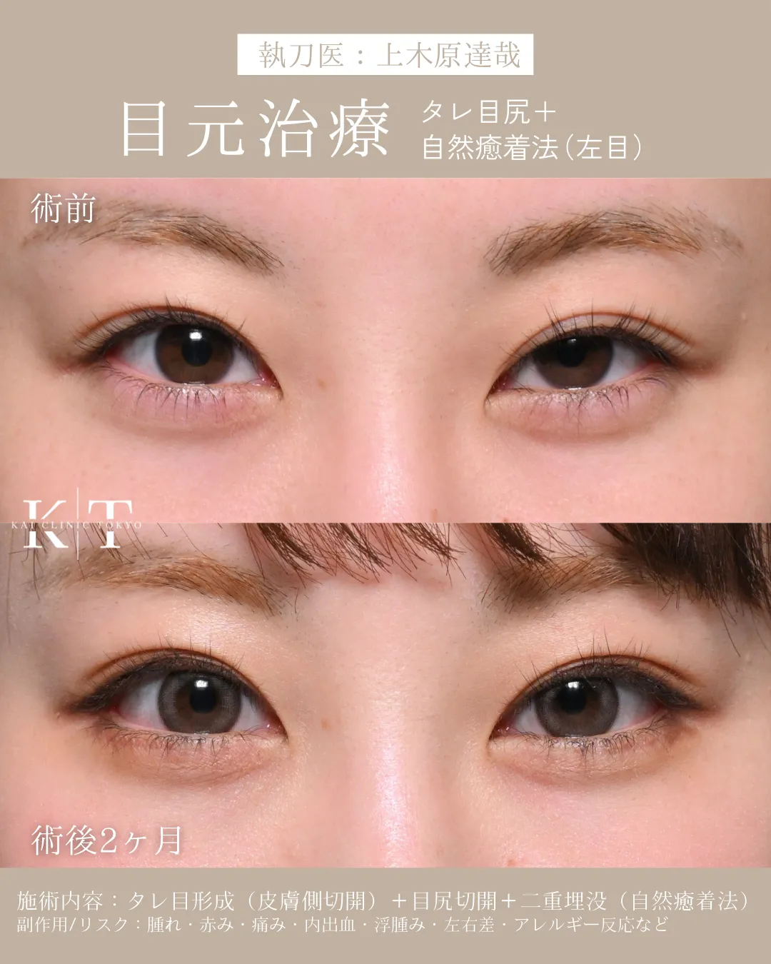 タレ目尻＋自然癒着法(左目)【20代女性】