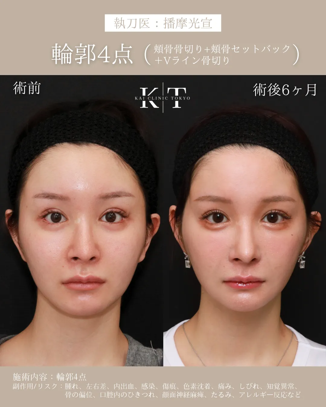 輪郭4点（頬骨セットバック+Vライン形成）【20代女性】