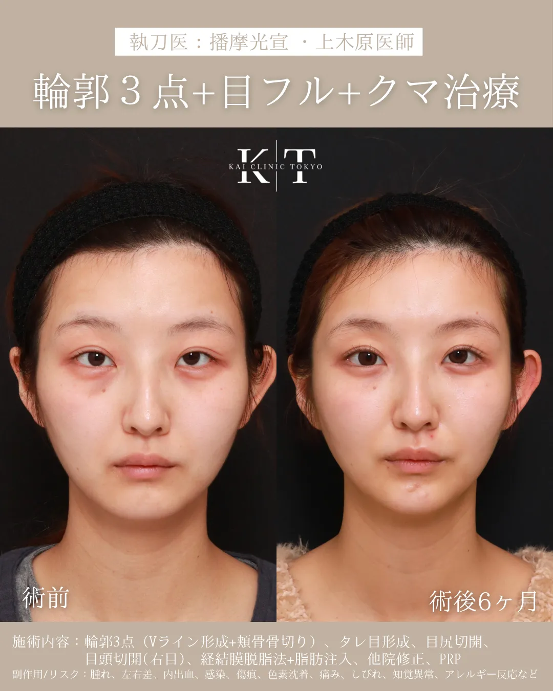 輪郭3点＋クマ治療【20代女性】