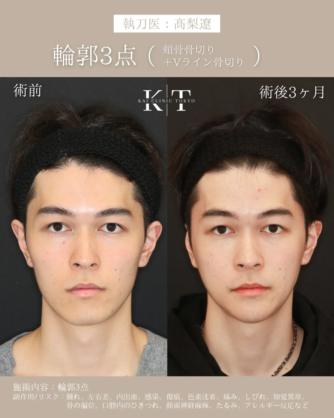 輪郭3点（頬骨骨切り+Vライン形成）【20代男性】