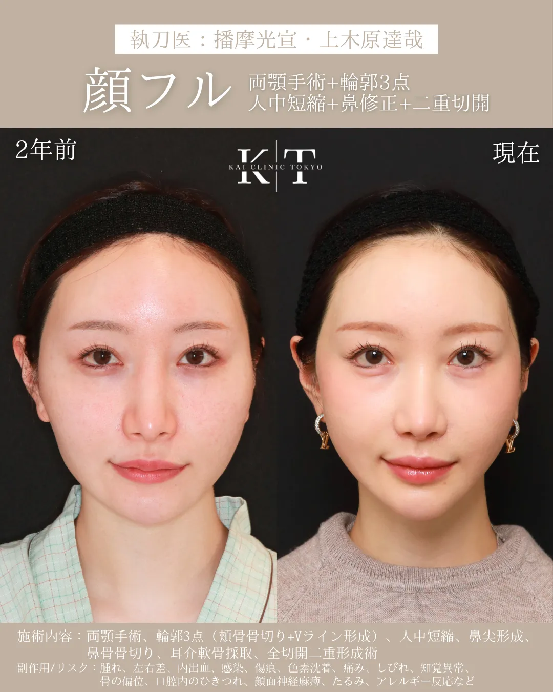 顔フル（両顎＋輪郭3点＋人中短縮＋鼻修正＋二重切開）【20代女性】